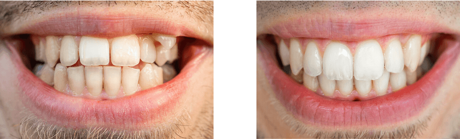 before after treatment